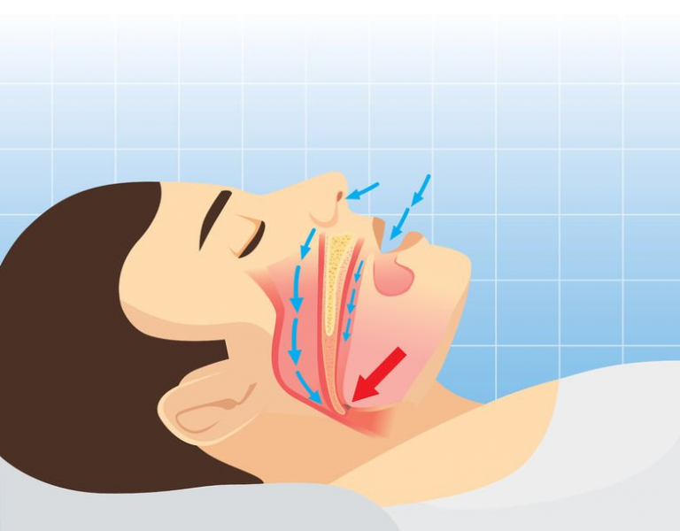 Nasal Breathing 101: What Is Disordered Breathing?